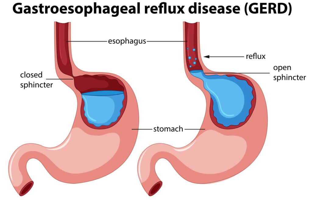 acid reflux